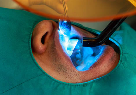 Restoring Decayed Teeth in Miami